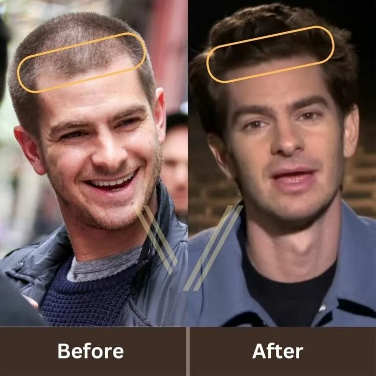 Hair transplant procedure