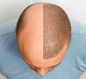 hair transplant procedure