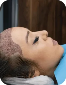 hair transplant procedure