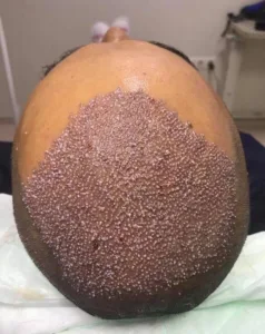 hair transplant procedure