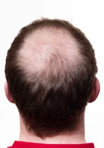 hair transplant procedure