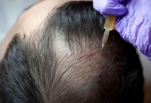 PRP treatment for hair and face