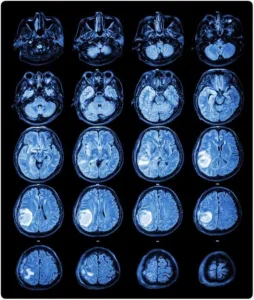 What are tumours? A brief description of tumors.